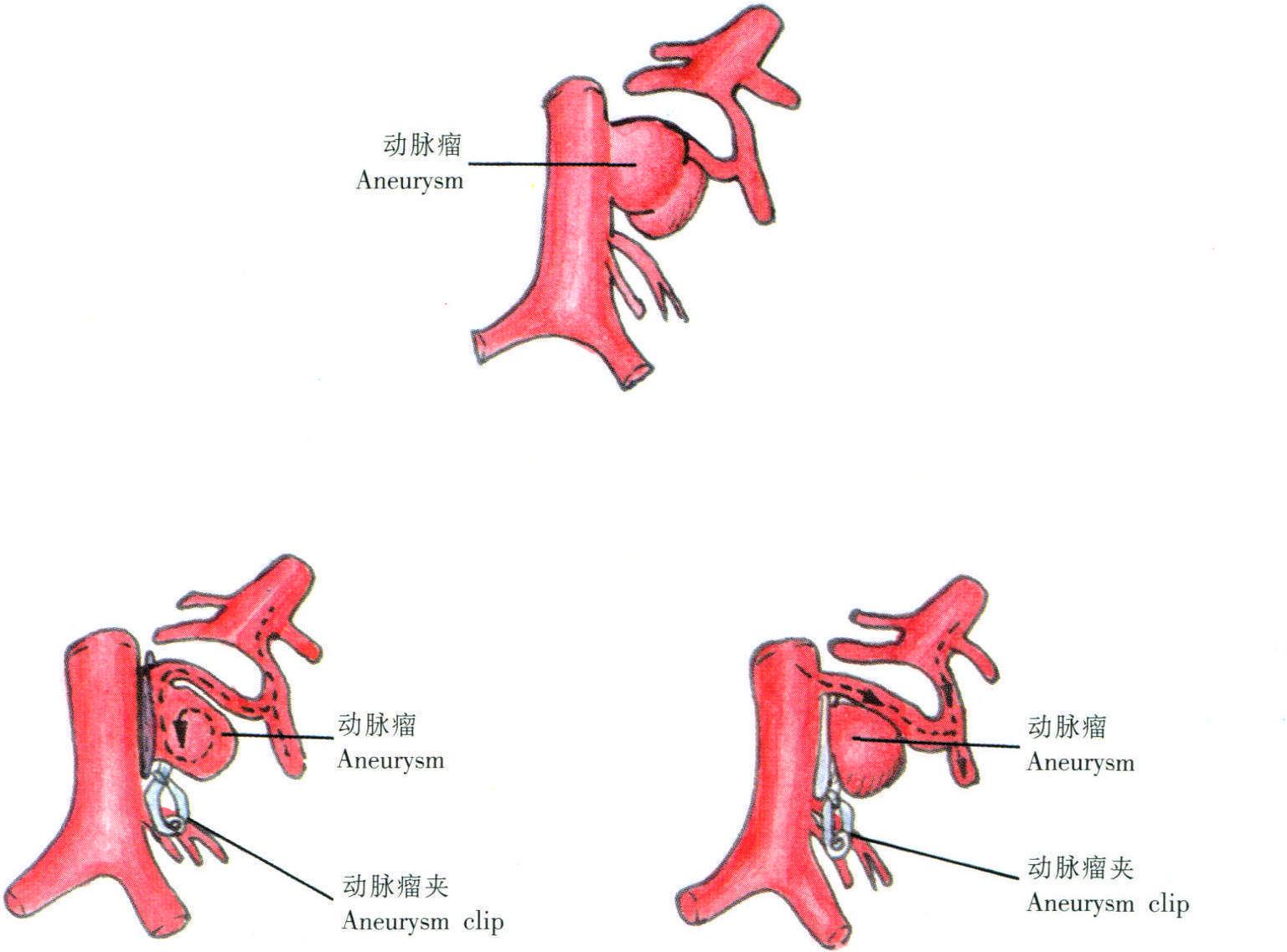 頸內(nèi)動(dòng)脈-后交通動(dòng)脈瘤夾閉術(shù) (二)